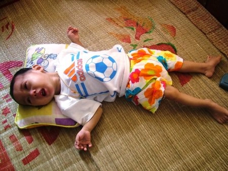 Hình ảnh mới nhất về bại liệt rõ ràng thực tế