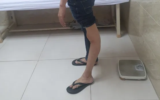 Triệu chứng qua hình ảnh bệnh bại liệt rõ rệt