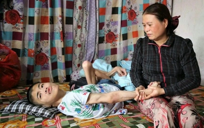 Cập nhật nhiều hình ảnh bại liệt kèm triệu chứng