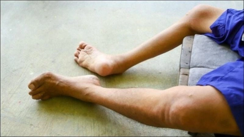 Cập nhật hình ảnh thực tế về bại liệt mới nhất