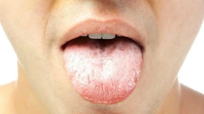 Hình ảnh bạch sản lưỡi ở người lớn tuổi rõ ràng dễ nhận biết