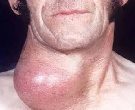 Tổng hợp hình ảnh bướu cổ mức độ nặng từ thực tế