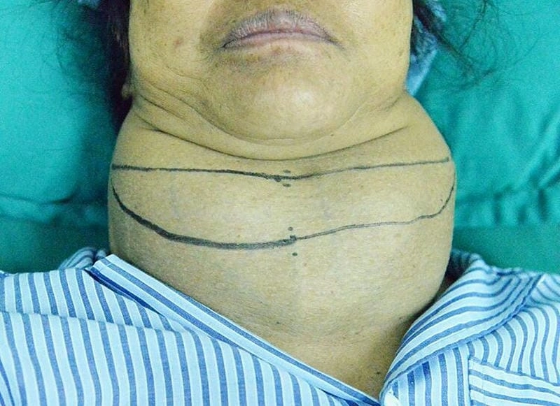 Dễ dàng nhận biết dấu hiệu bướu cổ lành tính qua ảnh thực tế