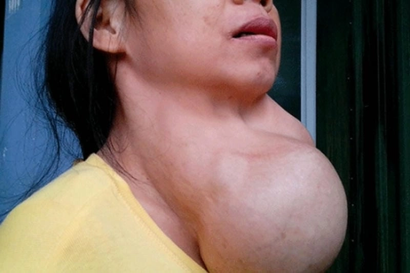 Đọc siêu âm bướu cổ dễ hiểu qua đối chiếu hình ảnh bệnh bướu cổ