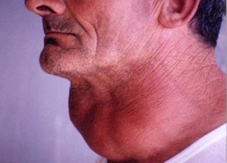 Xem rõ bướu cổ ở người già qua loạt ảnh thực tế