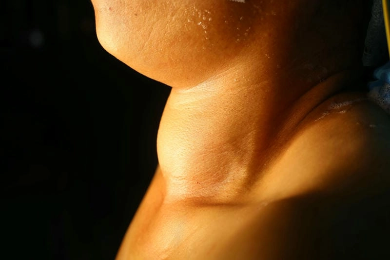 Phân biệt bướu cổ và cường giáp bằng hình ảnh bệnh bướu cổ