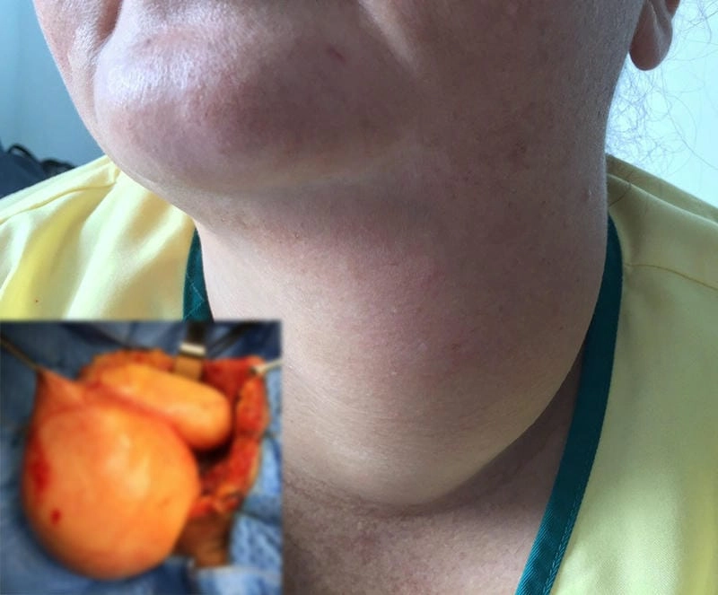 Xem ngay bướu cổ lành tính qua ảnh thực tế rõ ràng