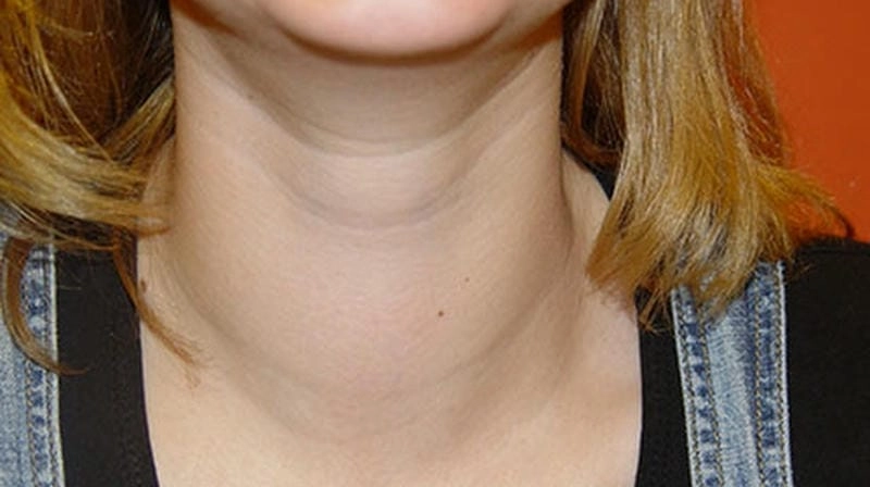Tìm hiểu rõ hình ảnh bệnh bướu cổ từ nhẹ đến nặng