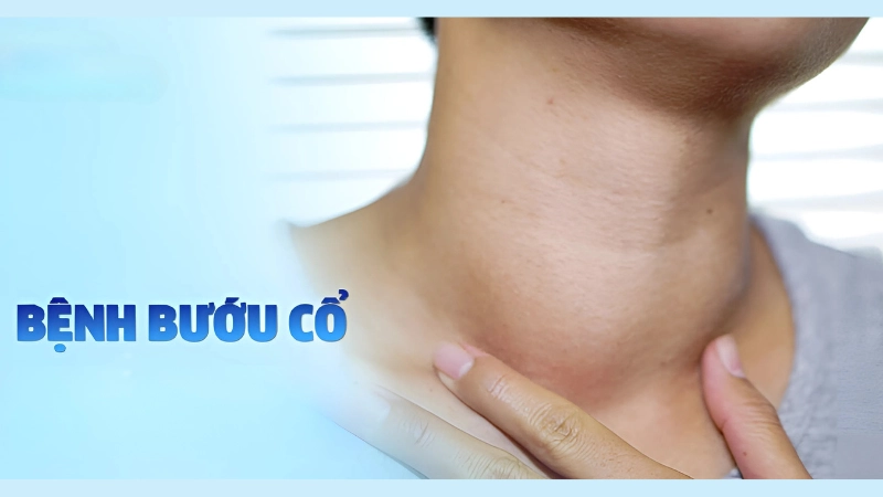 Hình ảnh bệnh bướu cổ là như thế nào