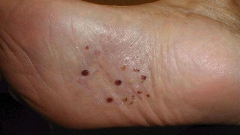 Tìm hiểu hình ảnh bệnh chàm chi tiết theo vùng da