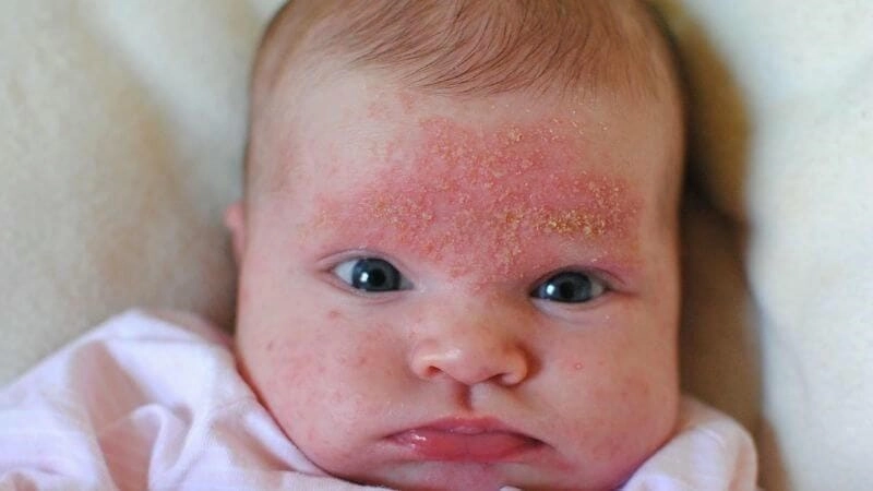 Cảnh báo hình ảnh bệnh chàm ở trẻ em cần biết