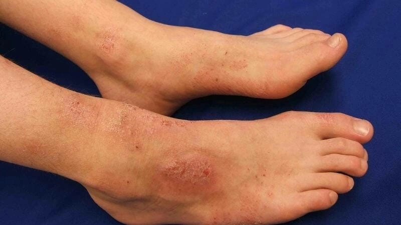 Tổng hợp rõ nét hình ảnh chàm các dạng phổ biến