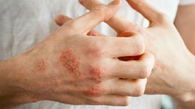 Hình ảnh chàm khô ở đầu ngón tay chi tiết