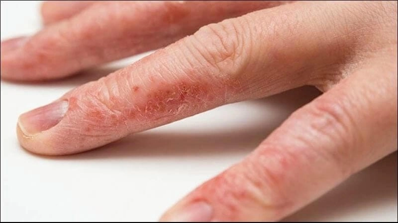 So sánh nhanh hình ảnh ghẻ chàm và chàm khô