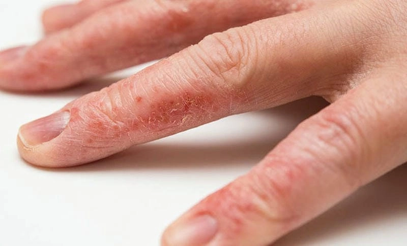 Cập nhật hình ảnh chàm da từ nhẹ đến nặng