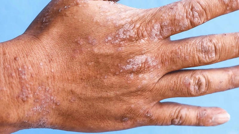 Tham khảo hình ảnh của bệnh chàm theo từng mức độ