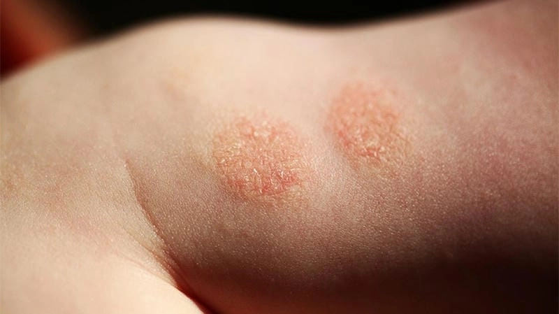 Đừng bỏ lỡ hình ảnh chàm khô xuất hiện quanh tay chân