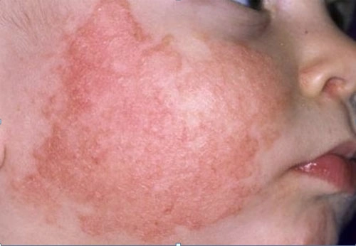 Xem kỹ hình ảnh chàm ở trẻ sơ sinh để kịp can thiệp