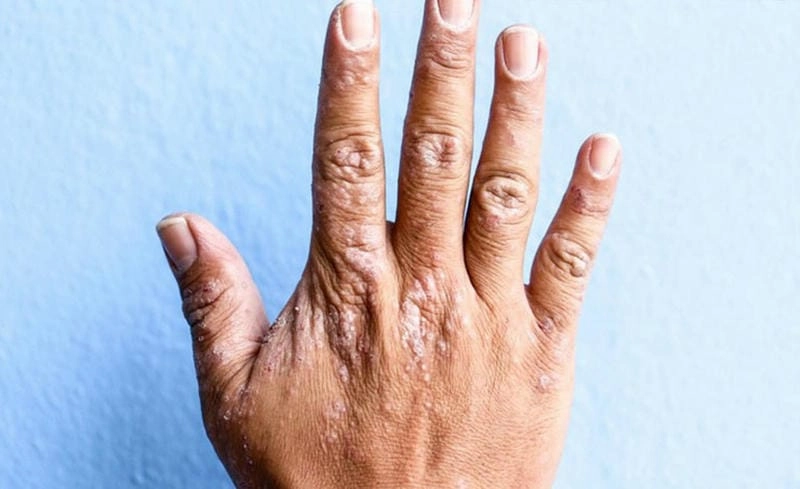 Phân biệt bệnh chàm khô ở tay qua ảnh chi tiết