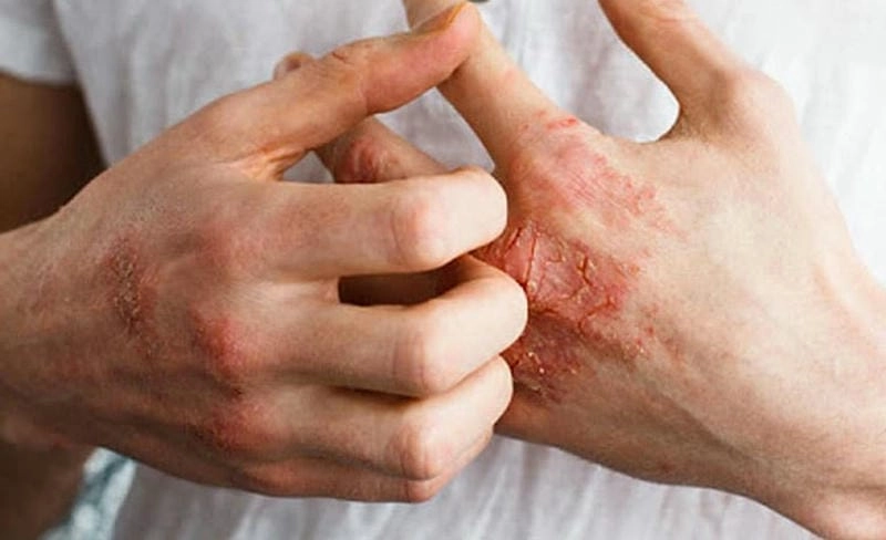 Xem nhanh dấu hiệu chàm khô ở tay thường gặp