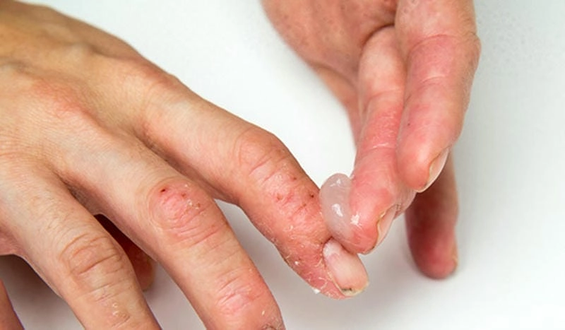 Đừng bỏ qua hình ảnh da bị chàm dễ bị nhầm lẫn