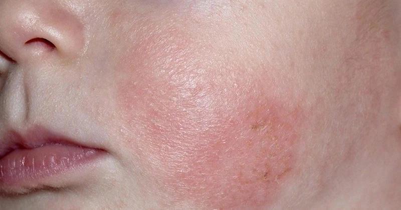 Cập nhật ảnh bệnh chàm ở trẻ em mới nhất hôm nay