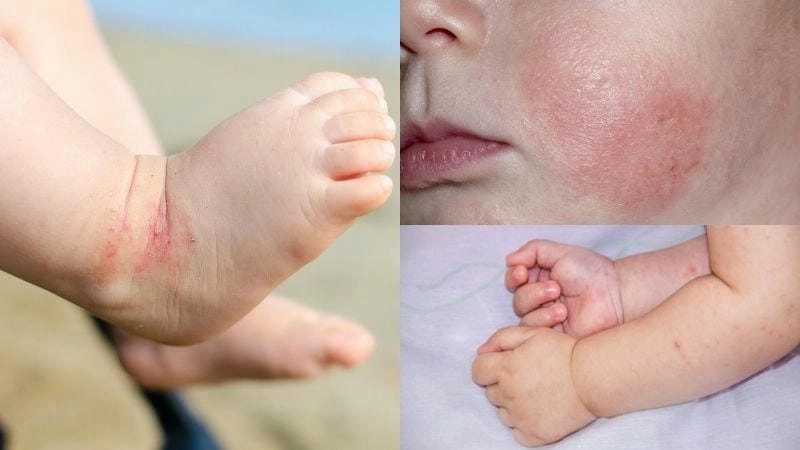 Tìm hiểu hình ảnh bị bệnh chàm ở trẻ em dễ hiểu