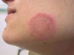 Khám ngay biểu hiện hình ảnh bé bị chàm đỏ thường gặp