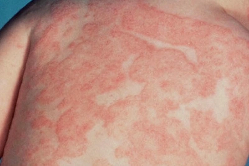 Dấu hiệu trẻ bị bệnh chàm và cách chăm sóc đúng