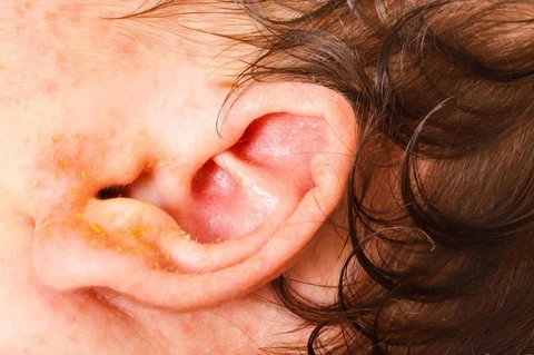 Tham khảo ngay ảnh trẻ bị chàm sữa và cách chữa trị