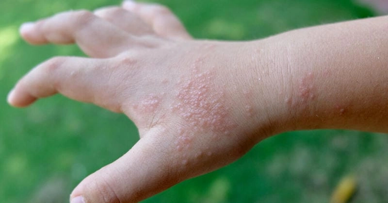 Tìm hiểu nguyên nhân bé bị chàm đỏ ở mặt hiện nay