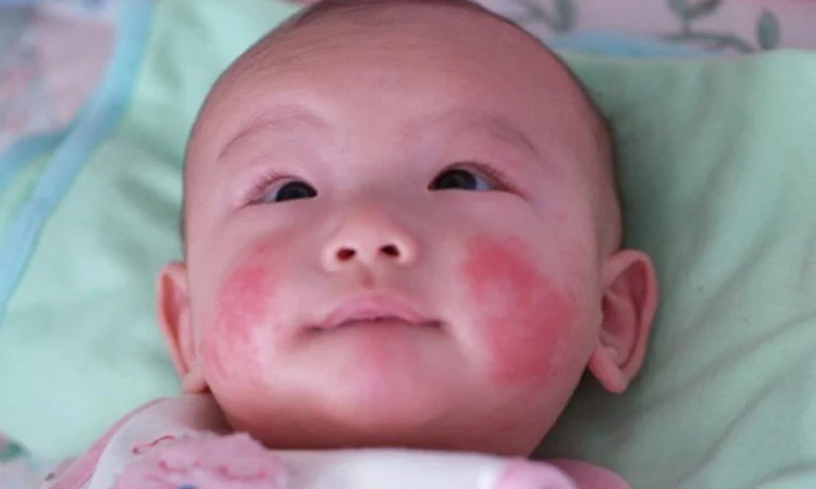 Xem nhanh dấu hiệu bé bị nổi chàm đỏ trên mặt nguy hiểm