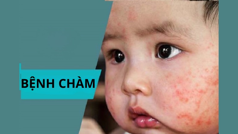 Bệnh chàm ở trẻ em là như thế nào gây hoang mang
