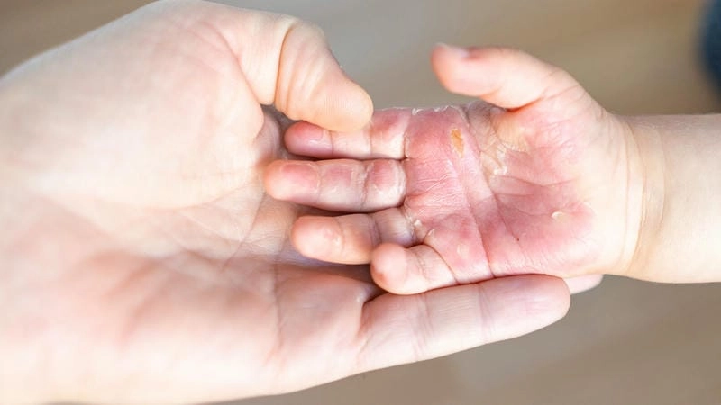 Khám phá hình ảnh bệnh chàm tổ đỉa rõ nét từng vùng da