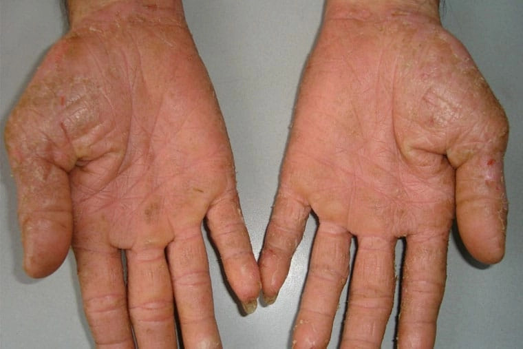 Xem ngay ảnh người bị chàm tổ đỉa ở bàn tay và chân