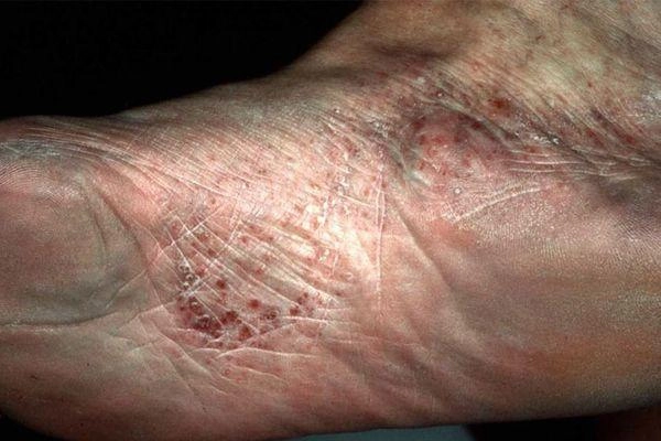 Xem nhanh loạt hình ảnh chàm tổ đỉa chi tiết rõ nét