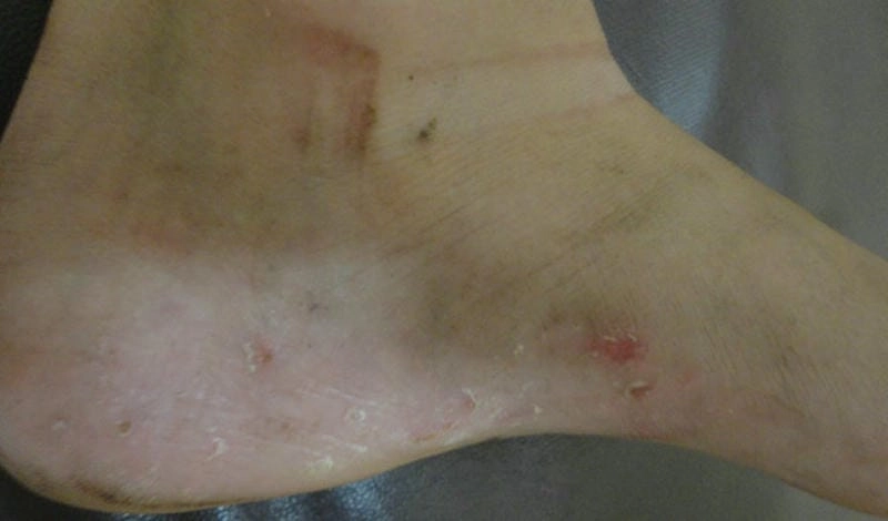 Tìm hiểu nguyên nhân gây bệnh chàm tổ đia thường gặp