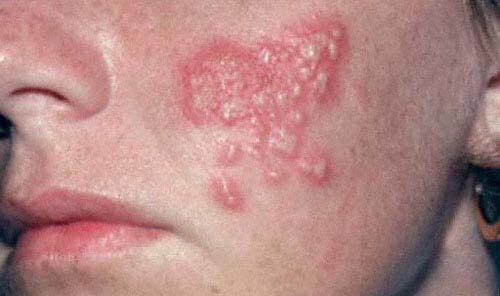 Tổng hợp đầy đủ ảnh bệnh chàm tổ đỉa từ thực tế