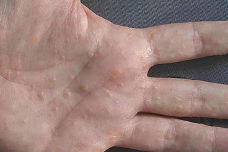 Tổng hợp phương pháp dân gian chữa chàm tổ đỉa