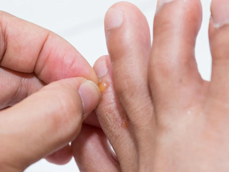 Tìm hiểu các cách chữa bệnh chàm to dia an toàn