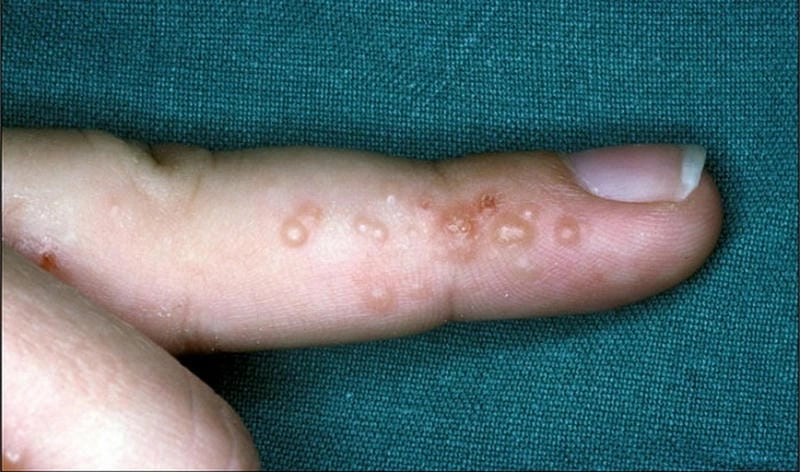 Các triệu chứng điển hình của chàm tổ đỉa dễ gặp