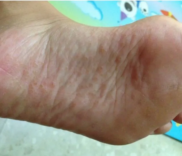 Cập nhật hình ảnh người bị chàm tổ đỉa theo từng giai đoạn