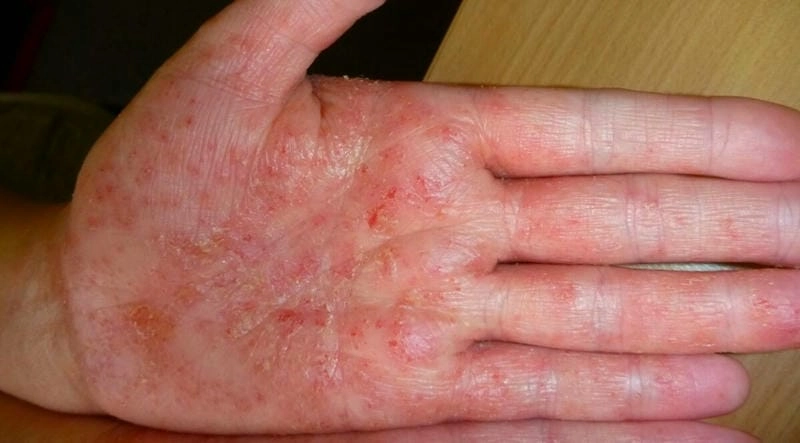 Giải đáp thắc mắc bệnh chàm tổ đỉa có lây không