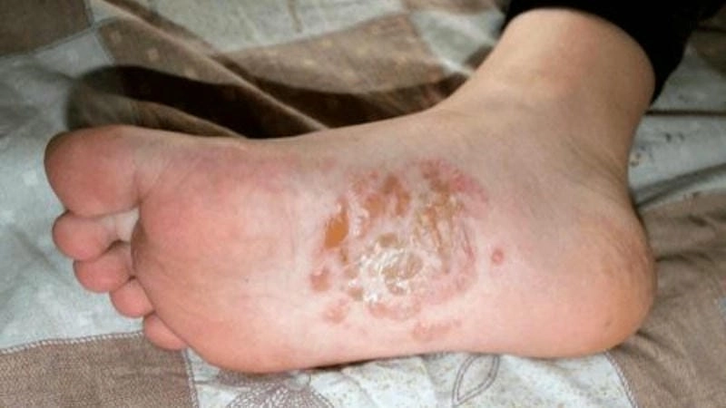 Hướng dẫn nhận biết sớm triệu chứng cham to dia