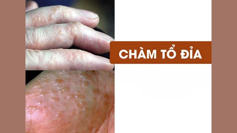 Hình ảnh bệnh chàm tổ đỉa là như thế nào