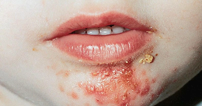 Dấu hiệu đặc trưng bệnh chốc bọng nước