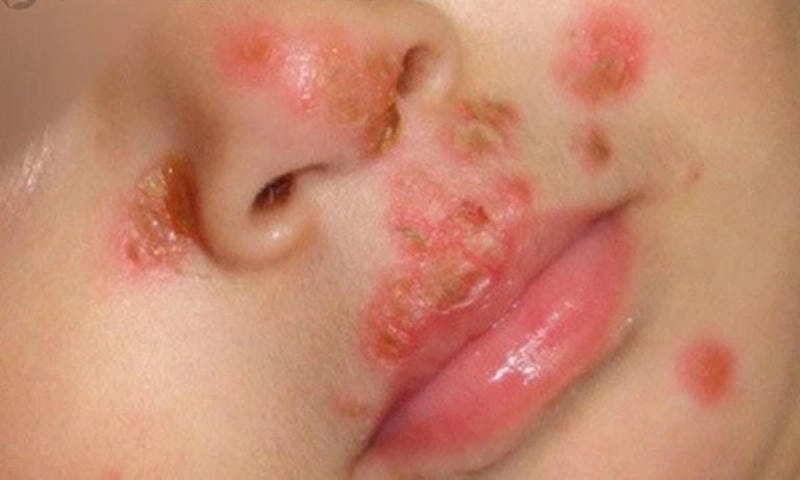 Phát hiện sớm bệnh chốc loét nguy hiểm