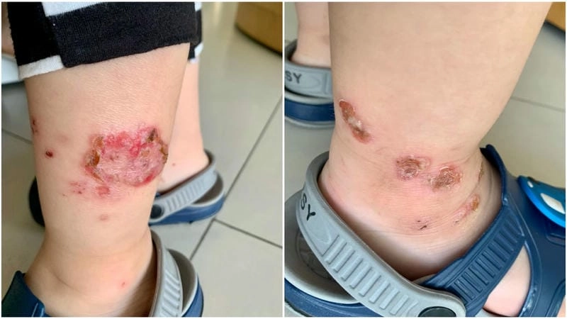 Phân tích kỹ hình ảnh bị chốc lở thật