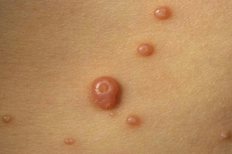 Nguyên nhân chính bị chốc lở ở trẻ em