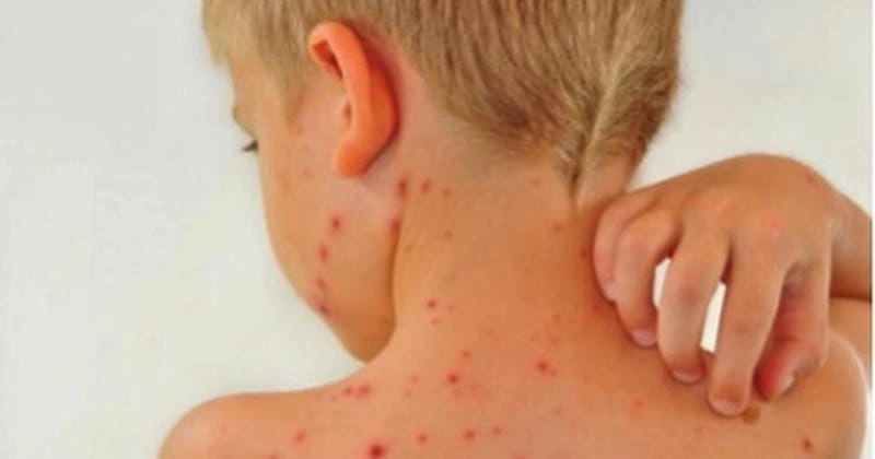 Hình ảnh bệnh chốc giúp xác định khi bị bệnh chốc